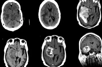 oligodendrogliomas astrocytomas