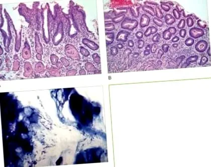 vérzéses gasztritisz akut gastritis