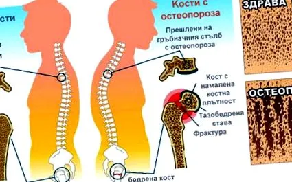 Állati eredetű osteoporosis