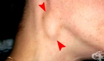 akut lymphadenitis