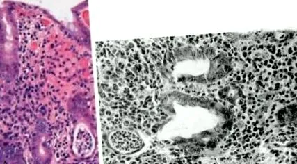 akut enteritis