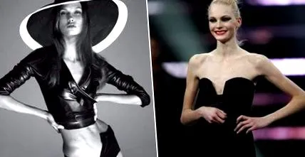 szépség anorexia