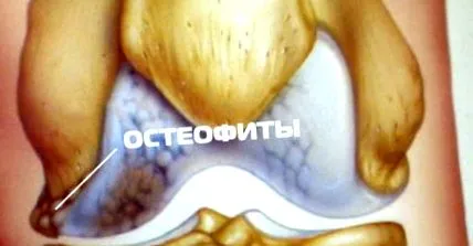 osteophyták kezelésében