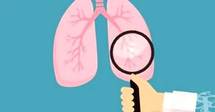 bronchitis akut