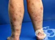 parapsoriasis plakkokkal