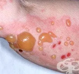 bullous pemphigoid heges pemphigoid