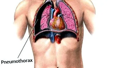 pneumothorax