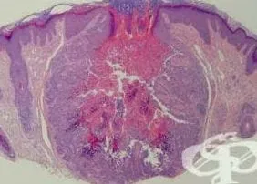 follikuláris dyskeratosis