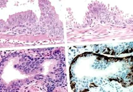 neoplasia prosztata
