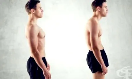 helyzeti kyphosis helyzeti kyphosis