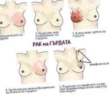 emlőrák kialakulásának