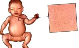 kezelés roseola