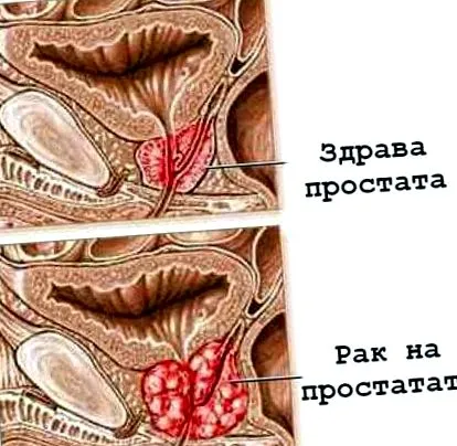 prosztatarák rákos sejtek