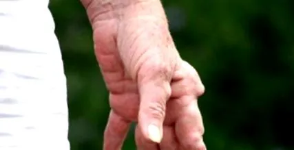 ősszel rheumatoid