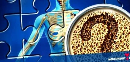 osteoporosis tényezői