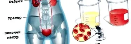 ismétlődő tartós haematuria