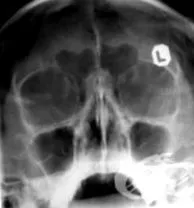 sinusitis hogyan
