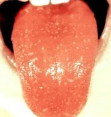 streptococcus fertőzés kezelés tünetek