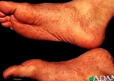 osteoarthritis
