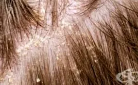 seborrheás dermatitis seborrhea