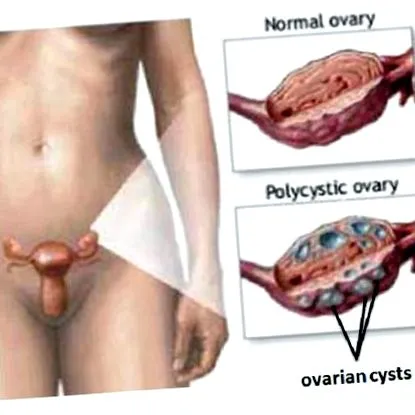 szindróma ovarian