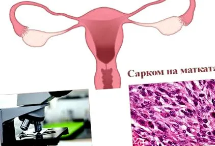 szarkóma gyakori vizelés