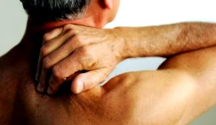 nyaki nyaki spondylosis
