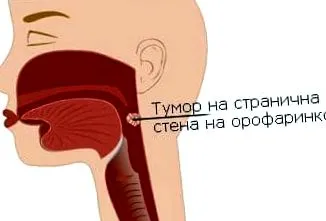 oropharynx oldalfalának