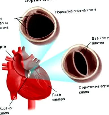 szűkület szelep
