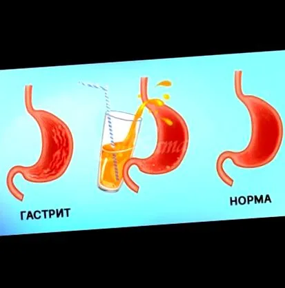 gyomorhurut gyümölcslevek