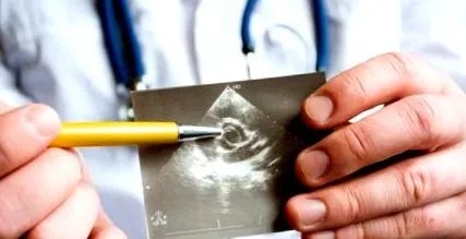 szívhalál aorta
