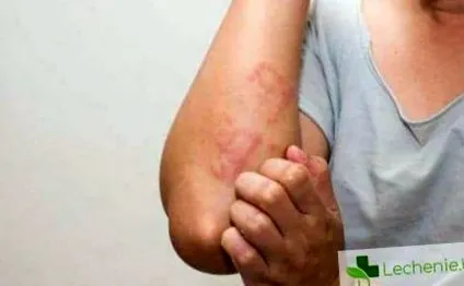 dermatitis vagy