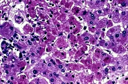 mint hepatitis