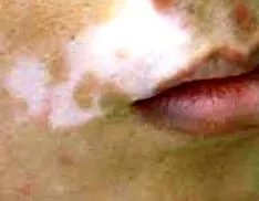 vitiligo egyik