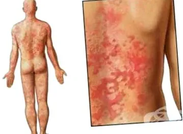Urticaria meghatározott Urticaria meghatározott