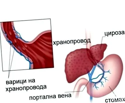 nyelőcső visszér