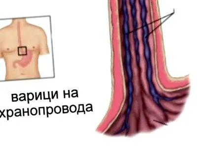 varikózus vénái