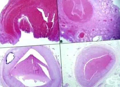 trombózisos embolia