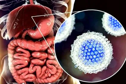 májgyulladás hepatitis B-ben