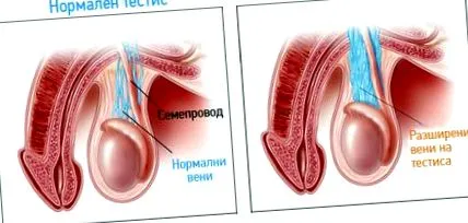 általános érzéstelenítést varicocele