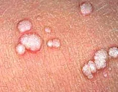figyelem papilloma vírus