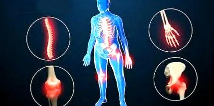 multiplex multiplex arthrosis