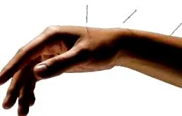 carpalis alagút