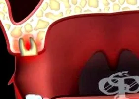 állkapocs alveolitis foghúzás után