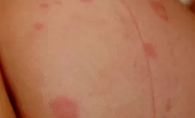 allergia