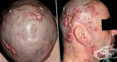 abszcesszív abszcesszív perifolliculitisének