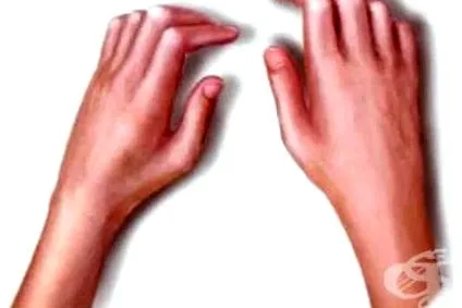 gyógymódok scleroderma