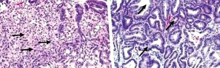 gyomor gyomor adenocarcinoma