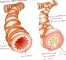 bronchiális