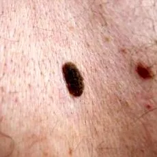 vakond nevus